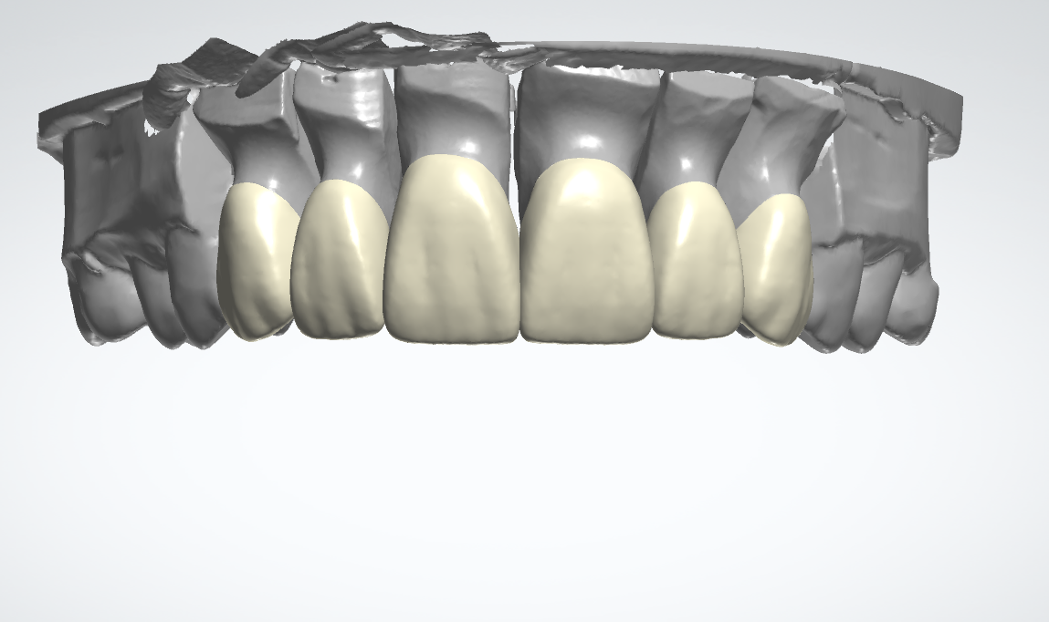 6-1 Units Anterior Design